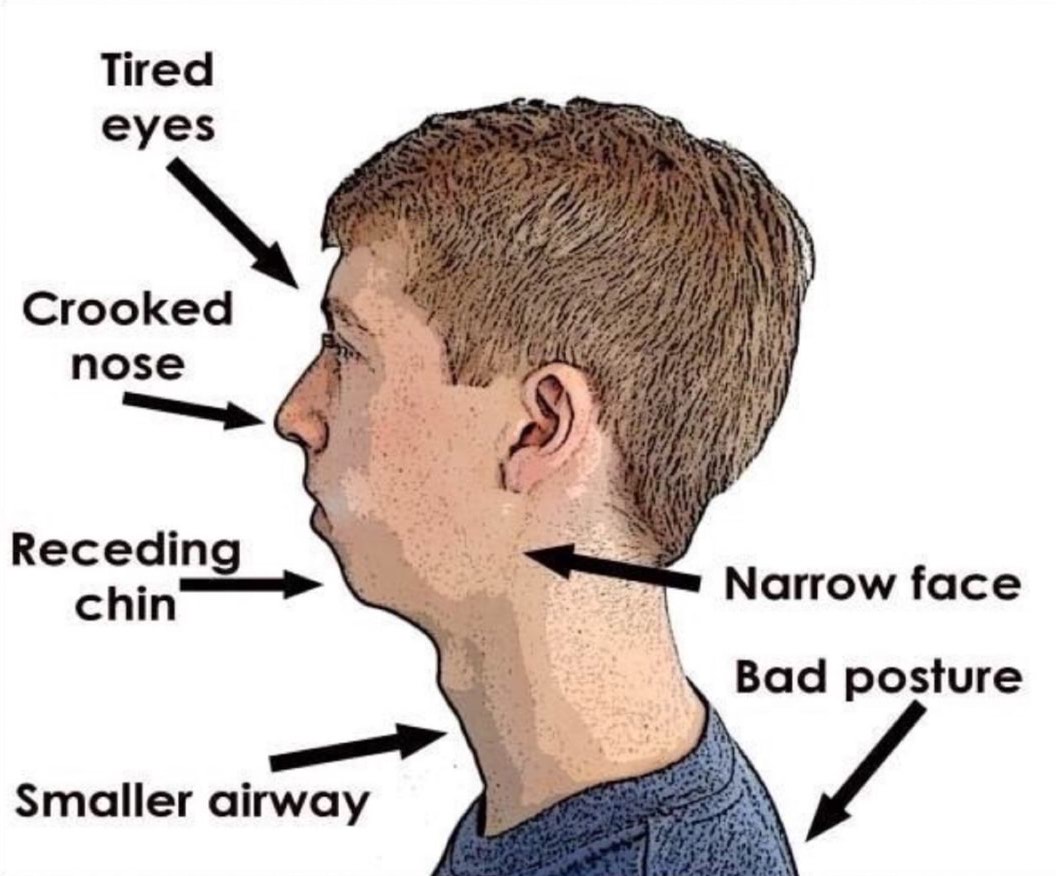 The Importance Of Airway Health From A Young Age