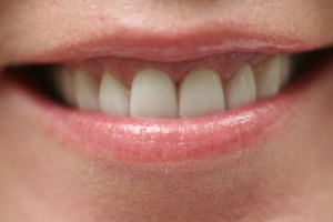 After Dental Surgery