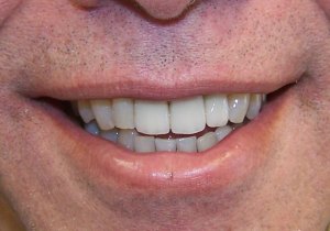 After Dental Implants
