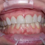 Before Dental Surgery