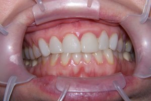 Before Dental Surgery