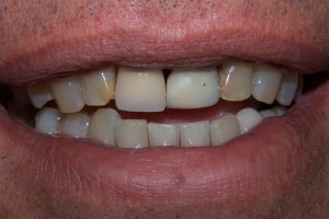 Before Dental Implants