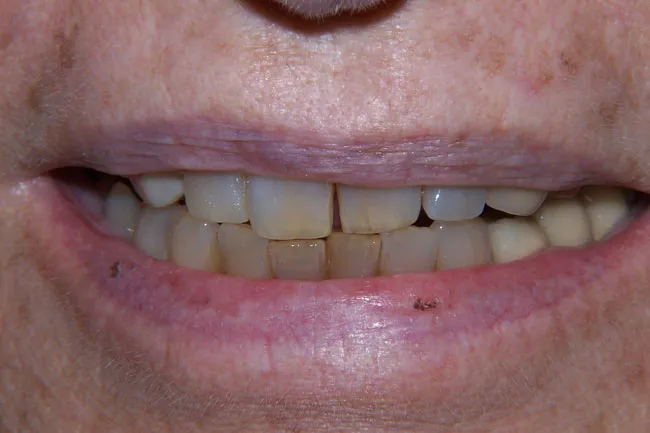 Before Dental Implant Surgery