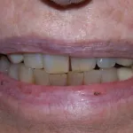 Before Dental Implant Surgery