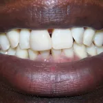 Teeth Before Dental Implants