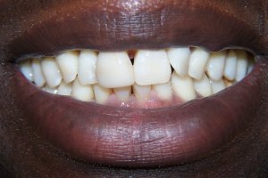 Teeth Before Dental Implants