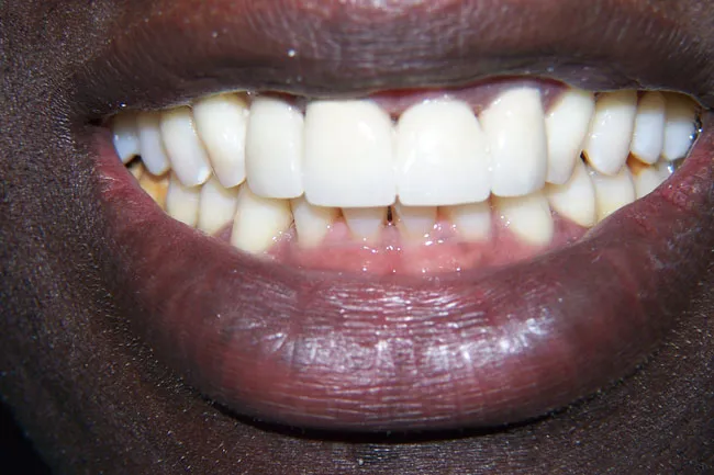 Teeth After Dental Implants