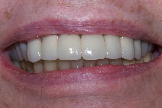After Dental Implant Surgery