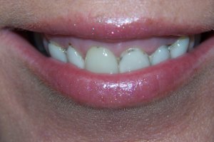 Before Dental Surgery