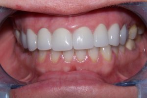 After Dental Surgery