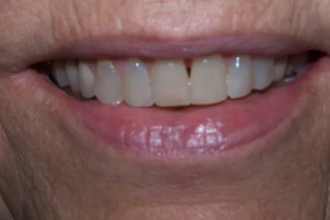 Before Dental Implants Placed