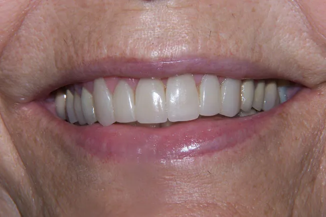 After Dental Implants Placed