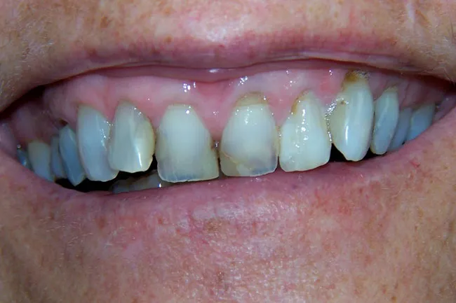 Before Dental Implant Procedure