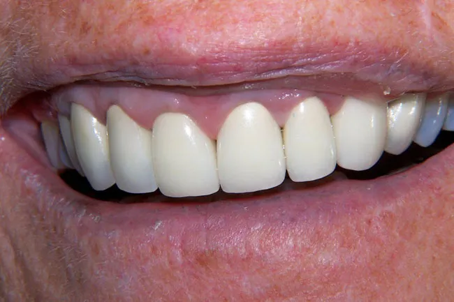 After Dental Implant Procedure