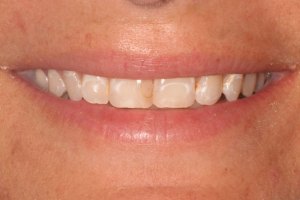 Before Dental Work