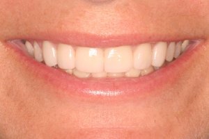 After Dental Work