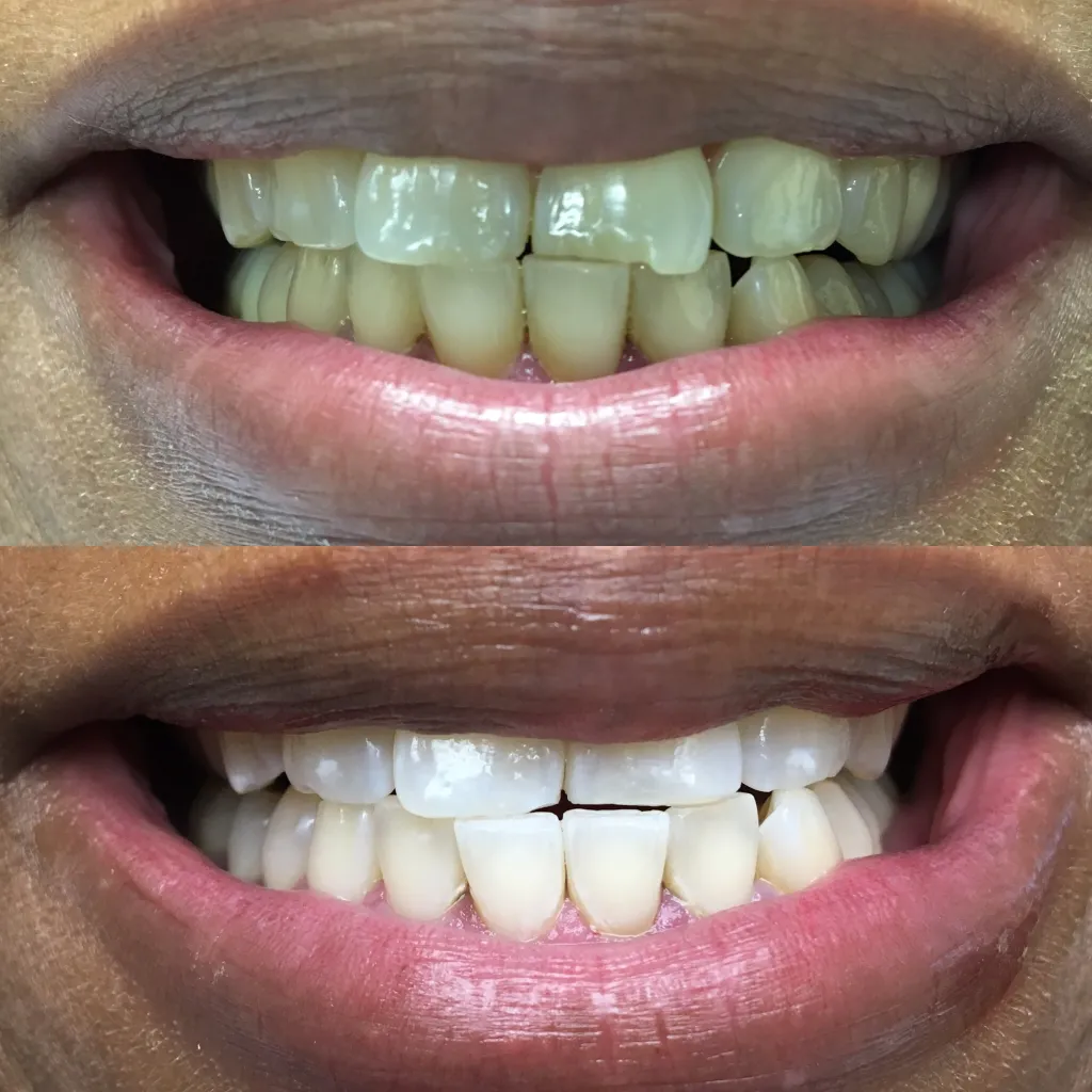 Comparison of dull smile before teeth whitening to bright smile after teeth whitening