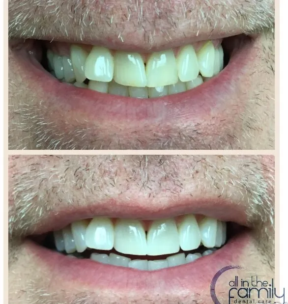 Yellow teeth before and white teeth after teeth whitening