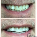 Yellow teeth before and white teeth after teeth whitening