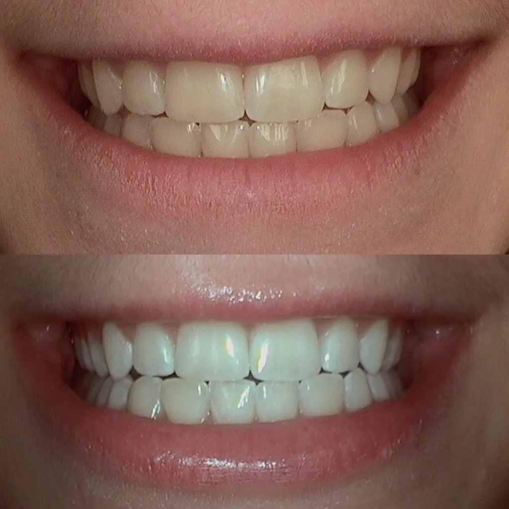 Before & After Teeth Whitening