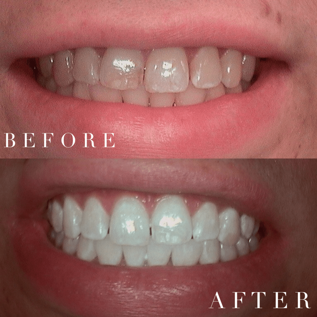 Before & After Teeth Whitening