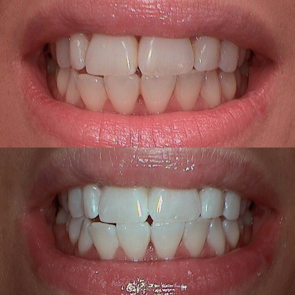 Before & After Teeth Whitening