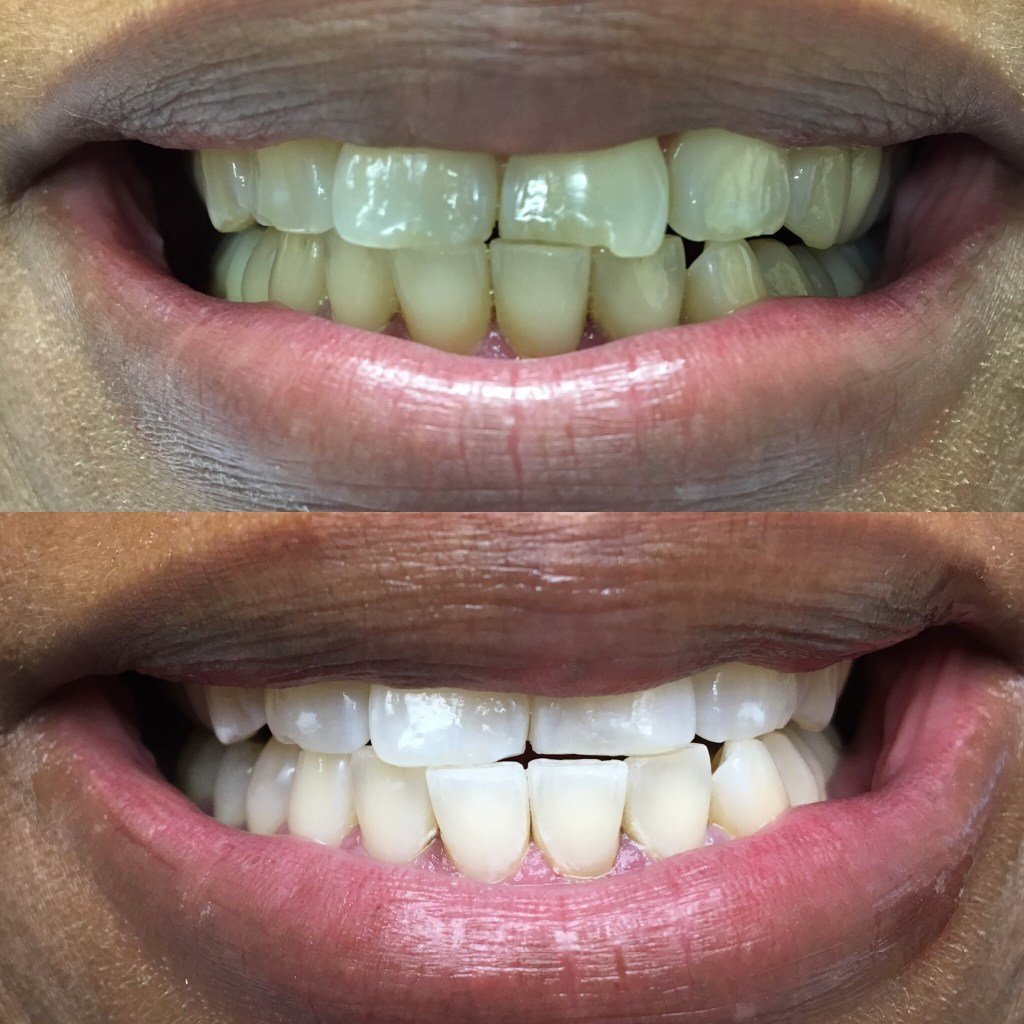 Before and After Teeth Whitening