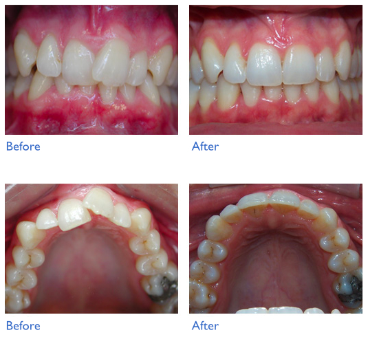 Comparison of teeth before and after Invisalign
