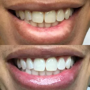 Comparison of dull smile before teeth whitening to bright smile after