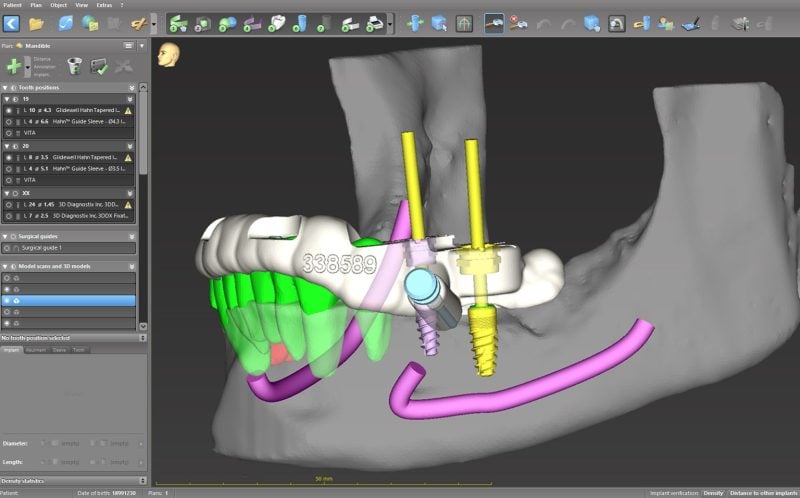 Guided Implant Surgery illustration
