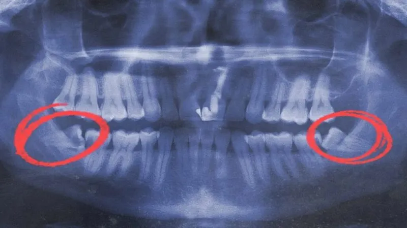 Impacted wisdom teeth: Symptoms and removal