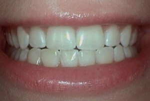 After Dental Surgery