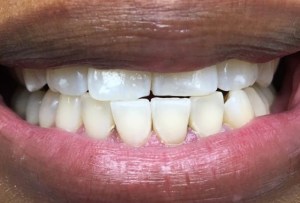 After Dental Surgery