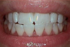 After Dental Surgery