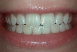 After Dental Surgery