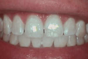 After Dental Surgery