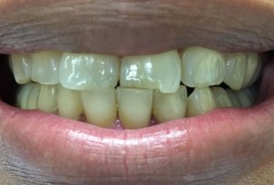 Before Dental Surgery