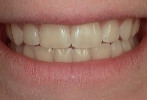 Before Dental Surgery
