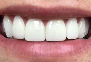 After Dental Surgery