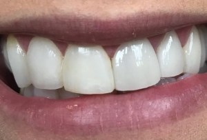 Before Dental Surgery